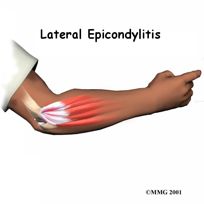 tennis elbow Tennis Elbow